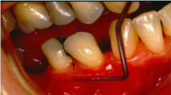 Measuring AG


Step 1: Measure Pocket Depth


Step 2: Measure distance from gingival margin to Mucogingival line/junction


Step 3: Subtract step 1 measurement from step 2


Confirmation of lack of AG


Coronal traction on probe  