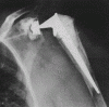 Early rev TSA designs (before the Grammont-style prosthesis) had a high failure rate due to early loosening of the glenoid component. What biomechanical feature accounted for this problem? 1- Glenoid component did not have a neck; 2-Hum component ...