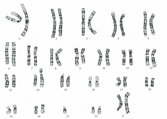 - Die Erbinformationen des Chromosoms Nummer 21 ist dreifach vorhanden, jedoch einmal an ein anderes Chromosom (meist Chromosom 14) angelagert
- Nicht vom Alter der Mutter abhängig, familiär gehäuft (kann aber auch als Neumutation auftreten)
- ...