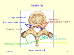 Chance’s fracture ou seat belt fracture :
Fracture vertébrale L1 et L2 (jct thoraco-lombaire) le + fréquemment implicant :
1) processus épineux
2) pédicules
3) corps vertébrale
Flexion-distraction (hyper-flexion; généralement causé par u...