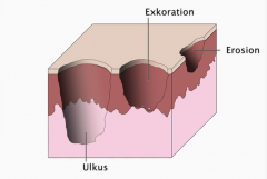 ・Ulkus (Geschwür)
- Tiefer Gewebedefekt bis in die Dermis oder Subkutis 
 
・Erosion
- Oberflächlicher Gewebedefekt 
 
・Exkoriation
- Oberflächlicher Gewebedefekt mit Blutung (bis in die obere Dermis reichend)