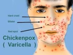 Chicken pox-- S/S / teaching/precautions