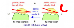 Quad contraction and geometry of femoral condyles 