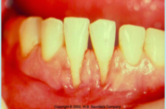 1. Accumulation of food particles during mastication


2. Impedes proper oral hygiene measures (with recession you have shallow vestibular depth and it's hard for the patient to angle the toothbrush to allow the bristles to get into the sulcus) 