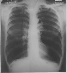 Diagnose CXR: hyperlucent lung fields with flattened diaphragms