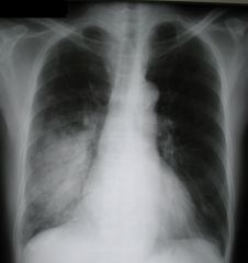 Diagnose CXR: opacification, consolidation, air bronchograms