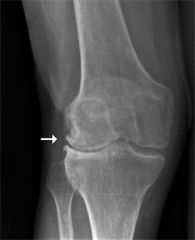 Diagnose: pt with knee pain, DIP involvement, no swelling or warmth at joints, worse at the end of the day, crepitus