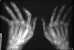 Diagnose: pt with arthritis at PIP and wrists bilaterally, worse in the AM, low grade fever