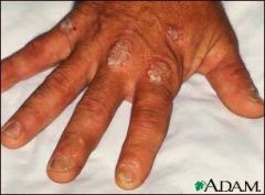 Diagnose: pt with arthritis at DIP joints, rash with silvery scale on elbows and knees, pitting nails, and swollen fingers