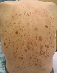 Name this skin sign of systemic disease (may indicate internal malignancy): explosive onset of multiple seborrheic keratoses