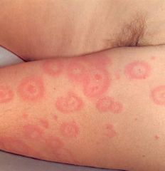 Pruritic rash that begins on extremities, lasts 7-10 d, unknown cause