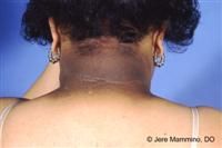 What is the Ddx of this skin findings (brown to black, poorly defined, velvety hyperpigmentation of the skin)