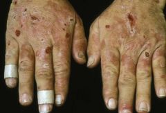 Diagnose: 50 yo male presenting with blisters which become ulcerated in areas of the skin exposed to sunlight, especially on the face, ears and dorsum of the hands; his labwork shows iron overload