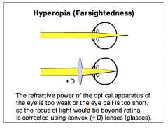 - Focus of objects positioned closer to the eye can be focused on the retina, even without the contribution of the usual mechanisms for near accommodation. 
- USE CONCAVE LENS TO CORRECT