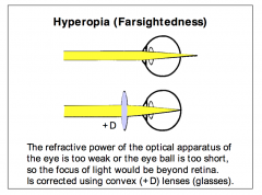 Objects in the far distance from the eye can still be brought into focus, by activating the mechanisms for near accommodation, which increase the refractive power of the eye.
- USE CONVEX LENS TO CORRECT
