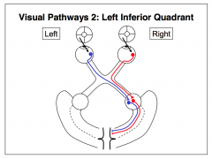 - Axons originating in the superior nasal quadrant of the retina of the left eye cross over at the optic chiasm, run in the contralateral (right) optic tract and synapse in the right lateral geniculate nucleus (LGN)
- The LGN fibers carry sensory informa