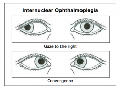 Internuclear ophthalmoplegia is based on a lesion of the medial longitudinal fasciculus (MLF), which prevents adduction of the eye on the side of the lesion during attempted lateral gaze.