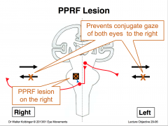 Lesions of the pontine gaze center (PPRF) result in a paralysis of ipsilateral horizontal eye movements. Conjugate horizontal gaze towards the side of the lesion is interrupted. When the left PPRF is damaged, for example, horizontal eye movements of both 