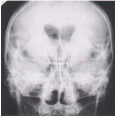 a small amount of cerebrospinal fluid is drained and replaced with air. The air travels towards the cranium in an upright patient and will reduce the radiodensity of the ventricles.
