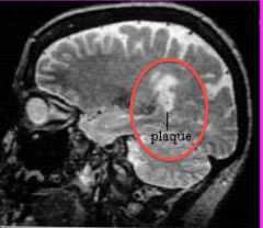 A specialized MRI scan called FLAIR may better reveal lesions from multiple sclerosis than a standard T2-weighted scan.