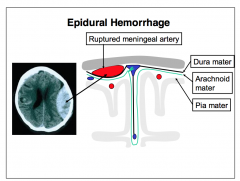 Epidural hemorrhages
commonly reflect the
traumatically induced
rupture of meningeal
arteries (e.g., middle
meningeal artery), with a
fractured bone cutting the
vessel. During the episode,
blood forces the stiff
periosteal dura to separate
from 