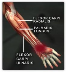 Action: Flexion (wrist)
Origin: Medial epicondyle of humerus
Insertion: Palmar aponeurosis & flexor retinaculum