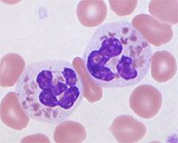 These two segmented neutrophils are characteristic of what disease?