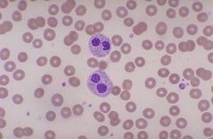 these two neutrophils exhibit hyposegmentation. what is this disorder called?