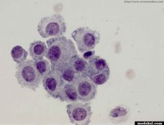 the following was observed in synovial fluid. what are the foamy cells observed?