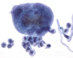 This giant multinucleated cell was seen in the cerebrospinal fluid. what is it?