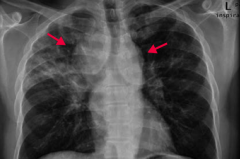 Sarcoidosis
- CXR shows bilateral suprahilar adenopathy (arrows) and right upper lung reticular opacity (often incidental findings on CXR)
- Common in black females
- Often asymptomatic except for enlarged lymph nodes