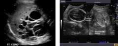 Ultrasound of kidneys
- Polycystic Kidney Disease
