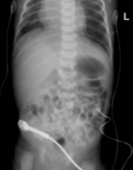 Abdominal X-ray
(normal bowel gas pattern, no free air)

Ultrasound Pylorus
(abnormal pyloric wall thickening and elongation without passage of gastric contents into proximal duodenum, consistent with hypertrophic pyloric stenosis)