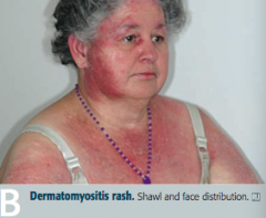 Dermatomyositis: perimysial inflammation and atrophy with CD4+ T cells