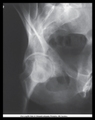 










Examine this AP oblique (Judet)
image of the right hip obtained with the patient positioned for the internal
oblique.  What patient position is
depicted in this image?  





