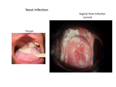   Vulvovaginal yeast infection  
painful, inflammatory condition of the female genital region that causes ulceration and whitish discharge

-caused by candida albicans
