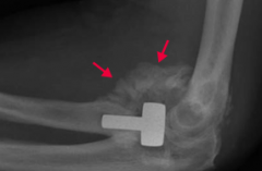 May present as a suspicious mass at a site of known trauma or as incidental finding on radiography