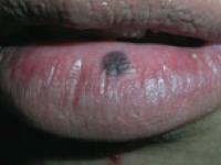 Macule
- Flat lesion with well-circumscribed change in skin color <1 cm
- Ex: freckles, labial macule (picture)