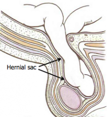 *happens if abdominal muscles are weak


-Intestines or peritoneal fat can push into inguinal canal, forming a hernia


-During standing, coughing or vigorous straining, contraction of IO & TA cause the roof of the canal to become lower & taut...