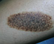 Patch
- Macule that is >1 cm (flat lesion with well-circumscribed change in skin color)
- Ex: large birthmark (congenital nevus) - picture