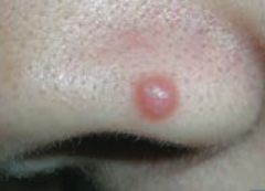 Papule
- Elevated solid skin lesion < 1cm
- Ex: mole (nevus) - picture, acne