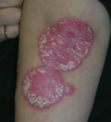 Plaque
- Papule >1 cm (elevated solid skin lesion)
- Ex: psoriasis (picture)