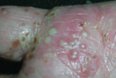 Pustule
- Vesicle containing pus
- Ex: pustular psoriasis