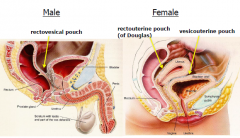 Deepest points of the peritoneal cavity, these are sites where infection and fluids typically collect.
Males: rectovesicle pouch
Females: rectouterine pouch (of douglass) and vesicouterine pouch