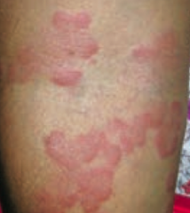 Wheal
- Transient smooth papule or plaque
- Ex: hives (urticaria)