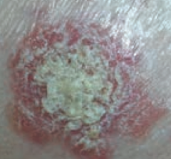 What type of lesion is this? Characteristics? Other examples?