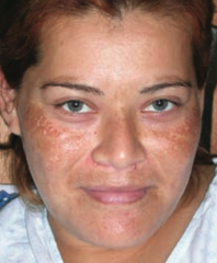 What disorder causes hyperpigmentation associated with pregnancy or OCP use?