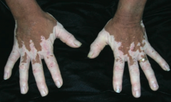 What disorder causes irregular areas of complete depigmentation? Cause?