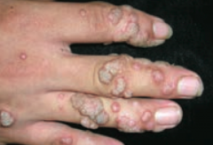 Which common skin disorder causes soft, tan-colored, cauliflower-like papules? Cause?