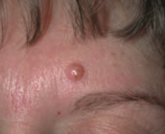 Melanocytic Nevus - intradermal nevi are papular
- AKA common mole